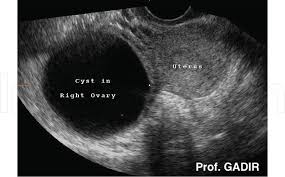 Many women have ovarian cysts at some time. Figure 1 From Chapter 5 Ovarian Cancer And Pregnancy Semantic Scholar