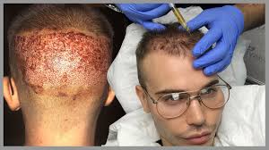 Check spelling or type a new query. My Uk Hair Transplant Surgery Experience Alexis Stone Youtube