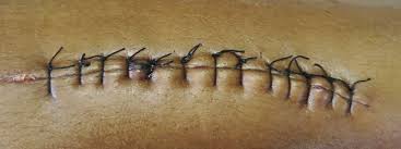 Tags for the entry eschar what eschar means in sanskrit, eschar meaning in sanskrit, eschar definition, explanation, pronunciations and examples of eschar in sanskrit. Wound Care A Guide To Practice For Healthcare Professionals