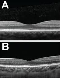 Retinal Physician What Oct Reveals About The Fovea