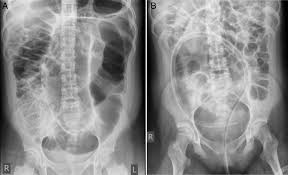 Image result for Sigmoid Volvulus