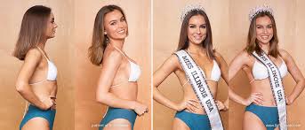 Because it is a cosmetic procedure, health insurance. Breast Enlargement Chicago Breast Augmentation Dr Turowski Plastic Surgery Chicago
