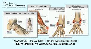 Lateral and medial malleolus fractures are treated with the same surgical techniques as written above for each fracture. Bimalleolar Fracture Bimalleolar Ankle Fracture Left Ankle Fracture Of The Medial Malleolus Ri Ankle Fracture Medical Malpractice Cases Medical Illustration