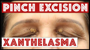 Image result for xanthelasma of eyelid