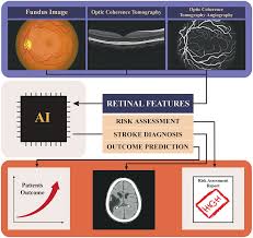 Artificial intelligence in stroke risk assessment and management via  retinal imaging - Frontiers