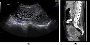 Nearly all cancers have their own specific markers. Tumour Markers And Their Utility In Imaging Of Abdominal And Pelvic Malignancies Sciencedirect