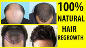 Regro Hair