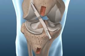 ACL Surgeon