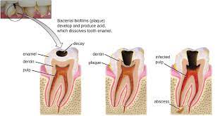 Microbial Diseases Of The Mouth And Oral Cavity Microbiology