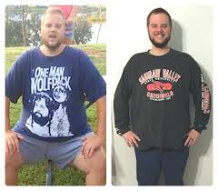 People who are undergoing gastric bypass surgery should make sure they can emotionally deal with all the alterations that will have to be made in their diet. Weight Loss Surgery Before And After Photos Health Travel Guide