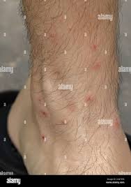Image result for mite bites on humans