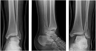 Image result for Ankle Dislocation