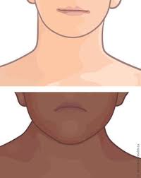 Image result for Webbed Neck