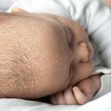 Image result for Cradle Cap