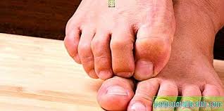 Semua orang tahu kolesterol tinggi boleh buatkan saluran darah ke jantung tersumbat, tapi ia takkan berhenti setakat tu. Ia Menyakitkan Ibu Jari Kaki Dalam Sendi Sebab Gejala Rawatan Pencegahan Dan Nasihat Doktor Penyakit Dan Keadaan 2021
