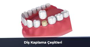 Zirkonyum kaplama her ne kadar diş kliniğinde hekim tarafından diş kesilip ölçüsü alınsada aslen laboratuar süreci çok meşakatlidir. Dis Kaplama Cesitleri En Iyi Dis Kaplama Tedavisi Hangileridir