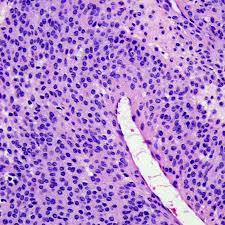 Image result for Glomus tumor