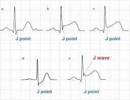 During an ecg, a technician uses electrodes, wires and a machine to. J Point Ecg Interval Litfl Ecg Library Basics