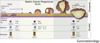 Over 40,000 new cancer cases or 42.4% of new cancer cases occur in this age group. Loss Of Nfkb1 Results In Expression Of Tumor Necrosis Factor And Activation Of Signal Transducer And Activator Of Transcription 1 To Promote Gastric Tumorigenesis In Mice Gastroenterology