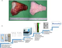 Because lymphoma is usually widespread, surgery alone is not usually appropriate. Proteomic Profiling And Identification Of Significant Markers From High Grade Osteosarcoma After Cryotherapy And Irradiation Scientific Reports