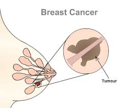 What is a Breast Cancer and How to Treat it