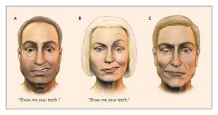 The most characteristic symptom of bell's palsy is the loss of expression in. Bell S Palsy Nejm