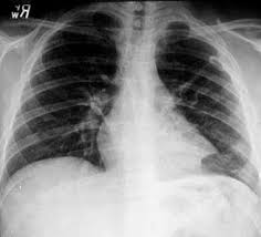 Image result for Parapneumonic Effusion