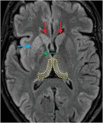 4.6 out of 5 stars. 74 Year Old Woman Presents With Rapidly Deteriorating Mental Status Over 3 Months Case 46 Emergency Radiology Coffee Case Book