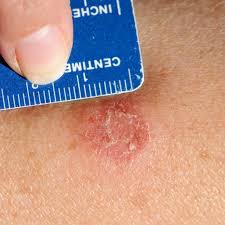 Image result for ringworm