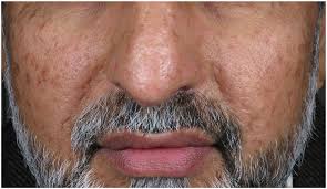 Energy-based devices for the treatment of Acne Scars: 2022 International  consensus recommendations