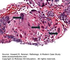 Cmv esophagitis linear ulcers owl's eye cells. Pathology Of The Gastrointestinal Tract Basicmedical Key