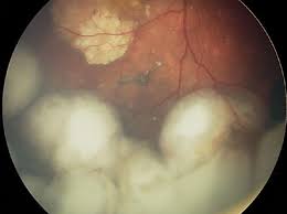 Melanoma is a kind of cancer that develops in cells that give your skin, eyes, and hair their color. For Retinoblastoma Testing Packaged Car T Cells National Cancer Institute