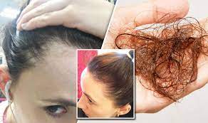 Foods rich in b vitamins also help keep hair follicles healthy, decreasing the risk for hair loss. Hair Loss Cure Breakthrough Treatment Found By Woman Who Lost Hair Express Co Uk