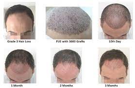 Your hair is going to look thicker, longer, and more intensive. After Fue