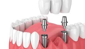 Our highly skilled implant surgeon. 10 Best Clinics For Dental Implant In Thailand 2021 Prices