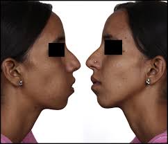 e Comparison of the right and left side of face revealing right sided...