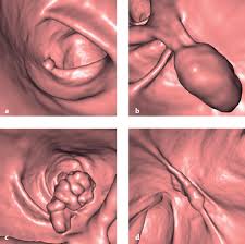 Colors (us), colours (uk) npl. Polypoid Lesions Of The Colon Abdominal Key