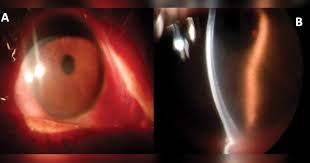 Air Assisted Lamellar Keratectomy For The Corneal Haze Model