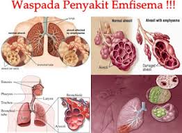 Contoh Tips Mengobati Penyakit Emfisema Menggunakan Bahan Herbal Catur