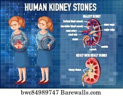 A big list of kidney jokes! 2 419 Kidney Stones Posters And Art Prints Barewalls