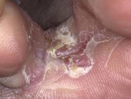 The fungus between the toes( epidermis)acute inflammatory reaction of the human body, manifested in the skin in the interdigital areas of the foot, in response to the livelihoods of anthropophilic fungi. Athlete S Foot Dermnet Nz