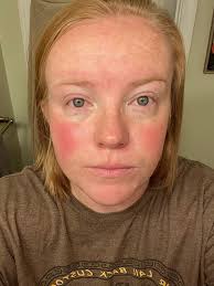 I have been trying for years to figure out this rash. The left side of my  face is the worst- cheek, ear, and sometimes eye. I've been through auto  immune testing and