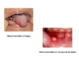 Learn vocabulary, terms and more with flashcards, games and other study tools. Ulceras De La Boca