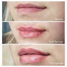 Check spelling or type a new query. Dermal Filler Before And Afters In Denver Co The Luxe Room