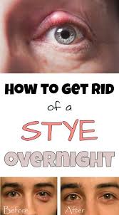 Eye Stye Remedies