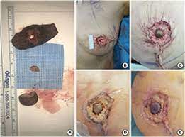 A higher rate of nac complications was seen with periareolar incisions (p = 0.02). Jbc Journal Of Breast Cancer