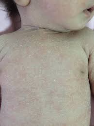 Image result for sweat rash on back baby