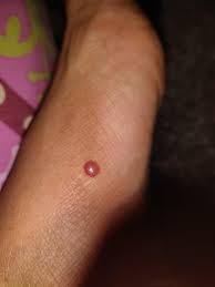 What Kind Of Bug Bite Bites On Legs Turning To Blisters Bites On Hands With Swelling And After Two Days A Pointed Head Will Come It S Very Itching I Moved To A