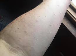 Check spelling or type a new query. Got A Browntail Moth Rash This Might Help