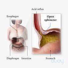 Acid reflux occurs when the sphincter muscle at the lower end of your esophagus relaxes at the wrong time, allowing stomach acid to back up into your esophagus. Acid Reflux Gerd Symptoms Diet Finding Relief Buoy